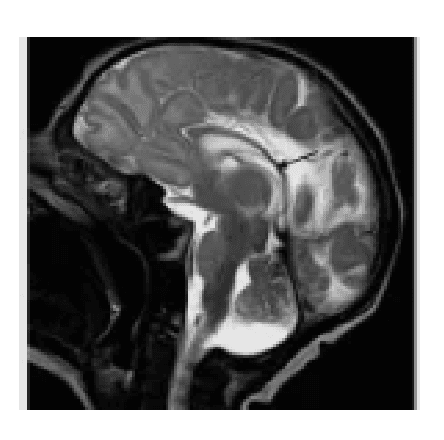 Resonancia magnética sagital de un cerebro